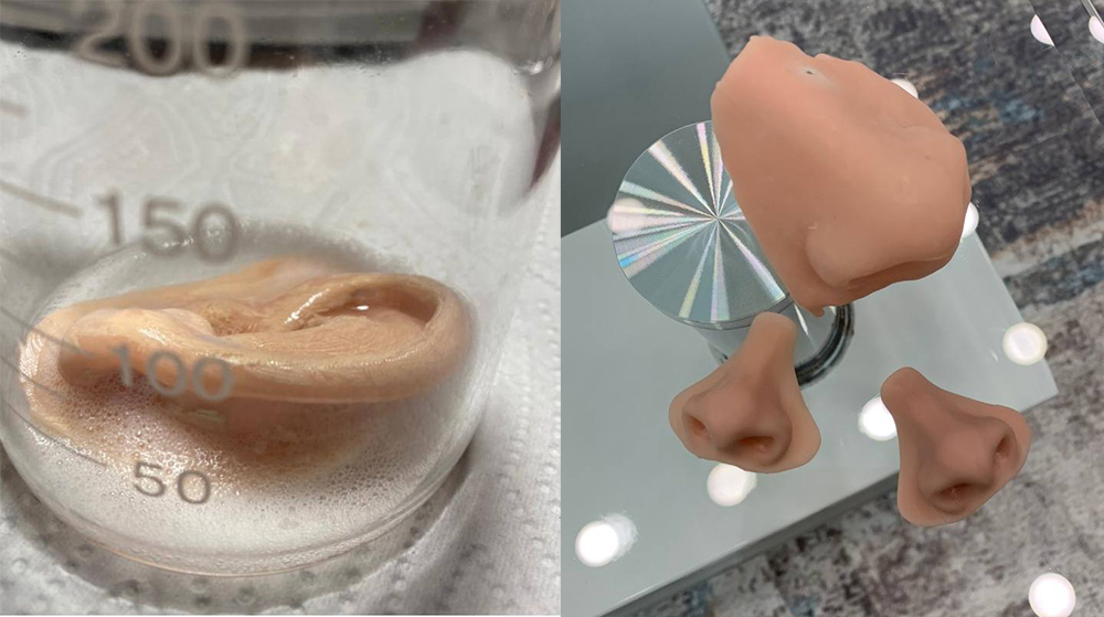 Фотополимерная 3D-печать в челюстно-лицевом протезировании